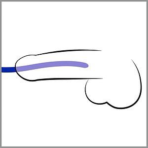 Dilatator Uretra Silicone Dilator Set Albastru Thumb 1